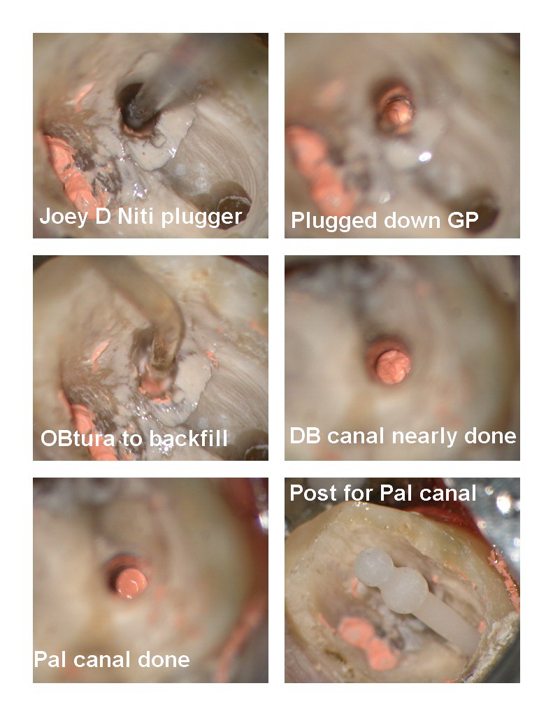 Endo first molar pg 3.jpg